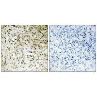 Immunohistochemistry analysis of paraffin-embedded human liver carcinoma tissue using TAF5 antibody.