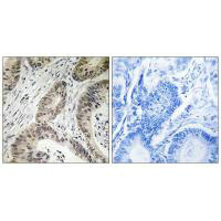 Immunohistochemistry analysis of paraffin-embedded human colon carcinoma tissue using TUT1 antibody.
