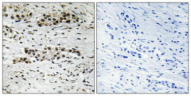 Immunohistochemical analysis of paraffin-embedded human breast carcinoma tissue using Estrogen Receptor-alpha (Phospho-Ser102) antibody (left)or the same antibody preincubated with blocking peptide (right).