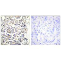 Immunohistochemistry analysis of paraffin-embedded human lung carcinoma tissue using MARK3 antibody.