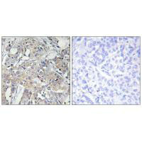 Immunohistochemistry analysis of paraffin-embedded human breast carcinoma tissue using Collagen VI alpha3 antibody. Immunohistochemistry analysis of paraffin-embedded human breast carcinoma tissue using Collagen VI alpha3 antibody.