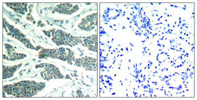Immunohistochemical analysis of paraffin-embedded human breast carcinoma tissue using AKT1/AKT2/AKT3(Ab-315/316/312) Antibody(left) or the same antibody preincubated with blocking peptide(right).