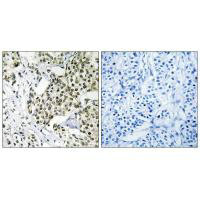 Immunohistochemistry analysis of paraffin-embedded human breast carcinoma tissue using CAGE1 antibody.
