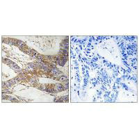 Immunohistochemistry analysis of paraffin-embedded human colon carcinoma tissue, using SERPINB9 antibody.