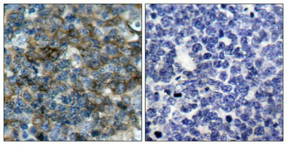Immunohistochemical analysis of paraffin-embedded human tonsil carcinoma tissue using VASP(Phospho-Ser157) Antibody(left) or the same antibody preincubated with blocking peptide(right).