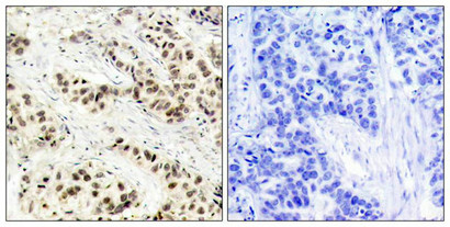 Immunohistochemical analysis of paraffin-embedded human breast carcinoma tissue using CDC2(Ab-15) Antibody(left) or the same antibody preincubated with blocking peptide(right).