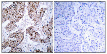 Immunohistochemical analysis of paraffin-embedded human breast carcinoma tissue using EGFR(Phospho-Tyr1092) Antibody(left) or the same antibody preincubated with blocking peptide(right).