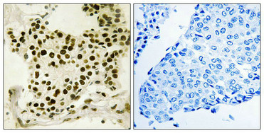 Immunohistochemistry analysis of paraffin-embedded human breast carcinoma tissue using UBF (Phospho-Ser484) antibody. The picture on the right is treated with the synthesized peptide.