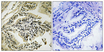 Immunohistochemical analysis of paraffin-embedded human prostate carcinoma tissue using PEK/PERK (Phospho-Thr982) antibody (left)or the same antibody preincubated with blocking peptide (right). Immunohistochemical analysis of paraffin-embedded human prostate carcinoma tissue using PEK/PERK (Phospho-Thr982) antibody (left)or the same antibody preincubated with blocking peptide (right).