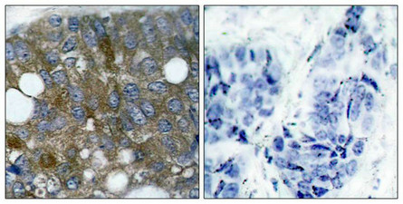 Immunohistochemical analysis of paraffin-embedded human breast carcinoma tissue using HSP27(Phospho-Ser15) Antibody(left) or the same antibody preincubated with blocking peptide(right).