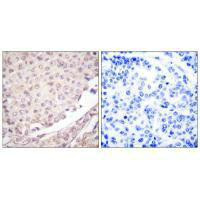 Immunohistochemical analysis of paraffin-embedded human lung carcinoma tissue using Cullin 1 antibody. Immunohistochemical analysis of paraffin-embedded human lung carcinoma tissue using Cullin 1 antibody.