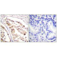 Immunohistochemistry analysis of paraffin-embedded human lung carcinoma tissue using RFA2 (Ab-21) antiobdy.