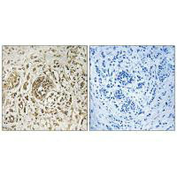 Immunohistochemistry analysis of paraffin-embedded human breast carcinoma tissue, using CIB2 antibody. Immunohistochemistry analysis of paraffin-embedded human breast carcinoma tissue, using CIB2 antibody.
