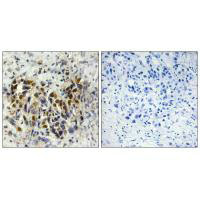 Immunohistochemistry analysis of paraffin-embedded human breast carcinoma tissue, using IRX3 antibody. Immunohistochemistry analysis of paraffin-embedded human breast carcinoma tissue, using IRX3 antibody.