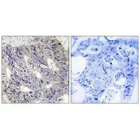 Immunohistochemistry analysis of paraffin-embedded human colon carcinoma tissue using ES8L1 antibody.