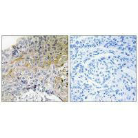 Immunohistochemical analysis of paraffin-embedded human breast carcinoma tissue using p130 Cas (Ab-410) antibody. Immunohistochemical analysis of paraffin-embedded human breast carcinoma tissue using p130 Cas (Ab-410) antibody.