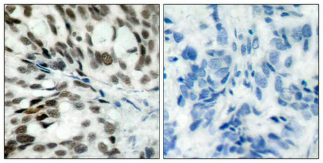 Immunohistochemical analysis of paraffin-embedded human breast carcinoma tissue using Rb(Ab-780) Antibody(left) or the same antibody preincubated with blocking peptide(right).