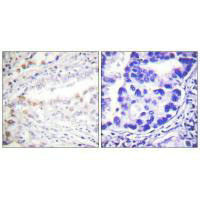 Immunohistochemistry analysis of paraffin-embedded human lung carcinoma tissue using Uba2 antibody.