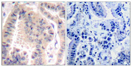 Immunohistochemical analysis of paraffin-embedded human lung carcinoma tissue using eIF4B(Ab-422) Antibody(left) or the same antibody preincubated with blocking peptide(right).