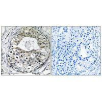 Immunohistochemistry analysis of paraffin-embedded human breast carcinoma tissue using RPS13 antibody.