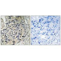 Immunohistochemistry analysis of paraffin-embedded human prostate carcinoma tissue using CMC1 antibody. Immunohistochemistry analysis of paraffin-embedded human prostate carcinoma tissue using CMC1 antibody.