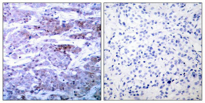 Immunohistochemical analysis of paraffin-embedded human breast carcinoma tissue using BAD(Ab-112) Antibody(left) or the same antibody preincubated with blocking peptide(right).