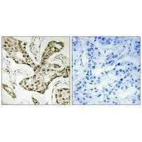 Immunohistochemistry analysis of paraffin-embedded human liver carcinoma tissue using TOP2A antibody.