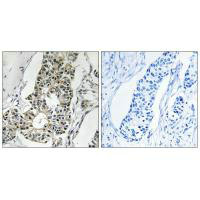 Immunohistochemistry analysis of paraffin-embedded human breast carcinoma tissue using RIMS4 antibody.