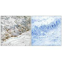 Immunohistochemistry analysis of paraffin-embedded human colon carcinoma tissue using GCHFR antibody. Immunohistochemistry analysis of paraffin-embedded human colon carcinoma tissue using GCHFR antibody.