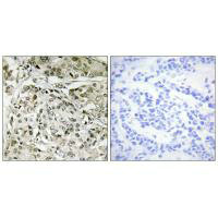 Immunohistochemistry analysis of paraffin-embedded human breast carcinoma tissue, using TAF1 antibody. Immunohistochemistry analysis of paraffin-embedded human breast carcinoma tissue, using TAF1 antibody.