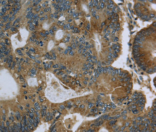 Immunohistochemical analysis of paraffin-embedded Human colon cancer tissue using at dilution 1/60. Immunohistochemical analysis of paraffin-embedded Human colon cancer tissue using at dilution 1/60.
