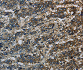 Immunohistochemical analysis of paraffin-embedded Human liver cancer tissue using at dilution 1/60.