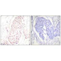 Immunohistochemistry analysis of paraffin-embedded human breast carcinoma tissue using SENP8 antibody.