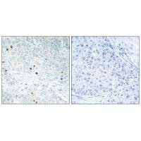Immunohistochemistry analysis of paraffin-embedded human breast carcinoma tissue, using TP53INP2 antibody. Immunohistochemistry analysis of paraffin-embedded human breast carcinoma tissue, using TP53INP2 antibody.