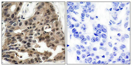 Immunohistochemical analysis of paraffin-embedded human breast carcinoma tissue using 4E-BP1(Ab-36) Antibody(left) or the same antibody preincubated with blocking peptide(right).