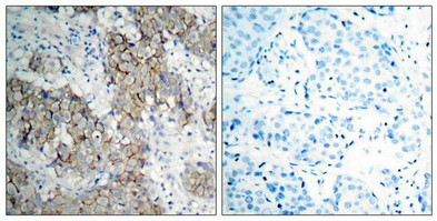 Immunohistochemical analysis of paraffin- embedded human breast carcinoma tissue using IGF-1R (phospho-Tyr1161) antibody.