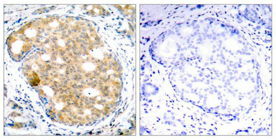 Immunohistochemical analysis of paraffin-embedded human breast carcinoma tissue using GSK3b(Ab-9) Antibody(left) or the same antibody preincubated with blocking peptide(right).