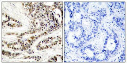 Immunohistochemical analysis of paraffin-embedded human breast carcinoma tissue using CREB(Phospho-Ser129) Antibody(left) or the same antibody preincubated with blocking peptide(right).