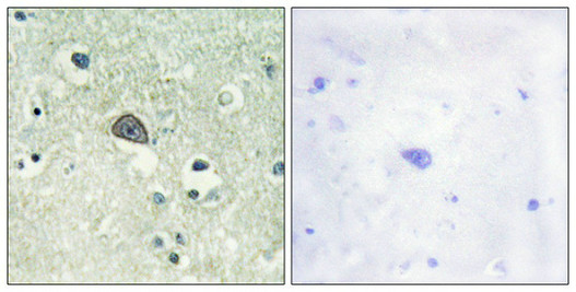 Immunohistochemical analysis of paraffin-embedded human brain tissue using NMDAR1 (Phospho-Ser890) antibody (left)or the same antibody preincubated with blocking peptide (right). Immunohistochemical analysis of paraffin-embedded human brain tissue using NMDAR1 (Phospho-Ser890) antibody (left)or the same antibody preincubated with blocking peptide (right).