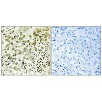 Immunohistochemistry analysis of paraffin-embedded human breast carcinoma tissue, using CTDSP1 antibody.