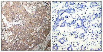 Immunohistochemical analysis of paraffin-embedded human breast carcinoma tissue using Keratin 18(Ab-33) Antibody(left) or the same antibody preincubated with blocking peptide(right).