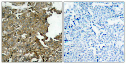 Immunohistochemical analysis of paraffin-embedded human breast carcinoma tissue using cofilin(Ab-3) Antibody(left) or the same antibody preincubated with blocking peptide(right).
