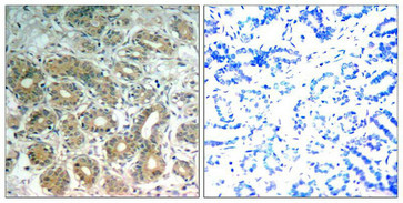 Immunohistochemical analysis of paraffin-embedded human breast carcinoma tissue using SHP-2(Ab-542) Antibody(left) or the same antibody preincubated with blocking peptide(right).