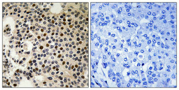 Immunohistochemical analysis of paraffin-embedded human breast carcinoma tissue, using PAK2 (Phospho-Ser197) antibody (left)or the same antibody preincubated with blocking peptide (right). Immunohistochemical analysis of paraffin-embedded human breast carcinoma tissue, using PAK2 (Phospho-Ser197) antibody (left)or the same antibody preincubated with blocking peptide (right).