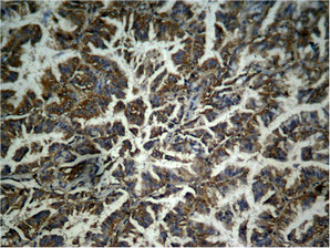 Immunohistochemical analysis of paraffin-embedded human lung carcinoma tissue, using beta-catenin (phospho-Tyr333) Antibody.