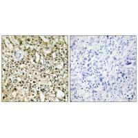 Immunohistochemistry analysis of paraffin-embedded human liver carcinoma tissue using Myc antibody.
