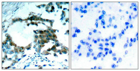 Immunohistochemical analysis of paraffin-embedded human lung carcinoma tissue using PKCth(Phospho-Ser695) Antibody(left) or the same antibody preincubated with blocking peptide(right).