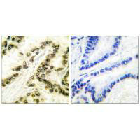 Immunohistochemical analysis of paraffin-embedded human breast carcinoma tissue using AP-2 antibody.