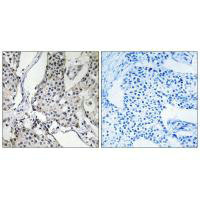 Immunohistochemistry analysis of paraffin-embedded human breast carcinoma tissue using PHLDA3 antibody.