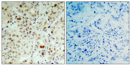 Immunohistochemical analysis of paraffin-embedded human breast carcinoma tissue using Rb(Phospho-Ser807) Antibody(left) or the same antibody preincubated with blocking peptide(right).